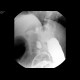 Tumorous stenosis of lienal flexure, severe stenosis, barium enema: RF - Fluoroscopy